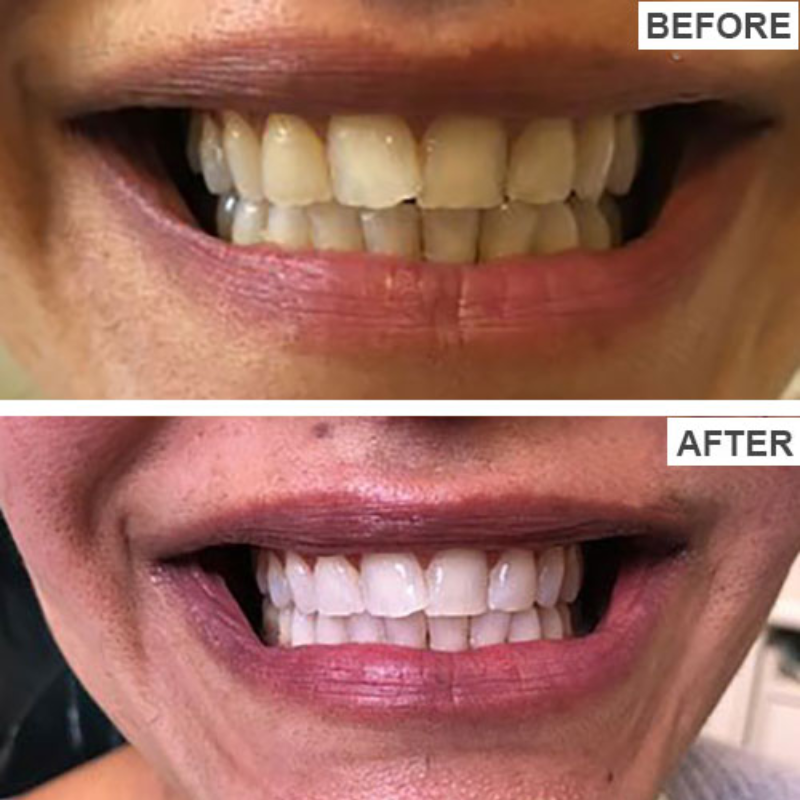 Teeth Whitening Strips (Pack of 56)