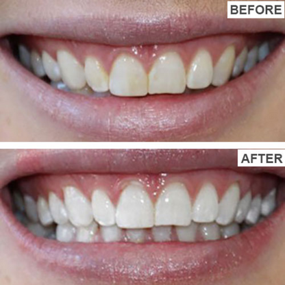 Teeth Whitening Strips (Pack of 56)